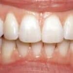 Dental before & after photos - Corbet Locke DDS - Woodway, TX