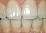 Dental before & after photos - Corbet Locke DDS - Woodway, TX