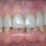 Dental before & after photos - Corbet Locke DDS - Woodway, TX