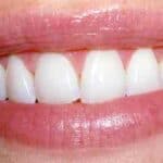 Dental before & after photos - Corbet Locke DDS - Woodway, TX