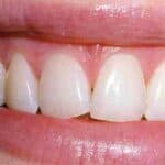 Dental before & after photos - Corbet Locke DDS - Woodway, TX